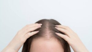 女性の薄毛は「気づいた時がスタートライン」